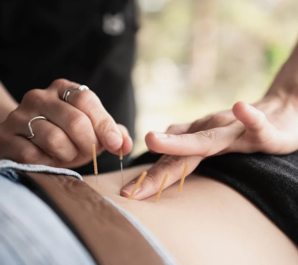 Practitioner performing acupuncture treatment on a patient's abdomen.
