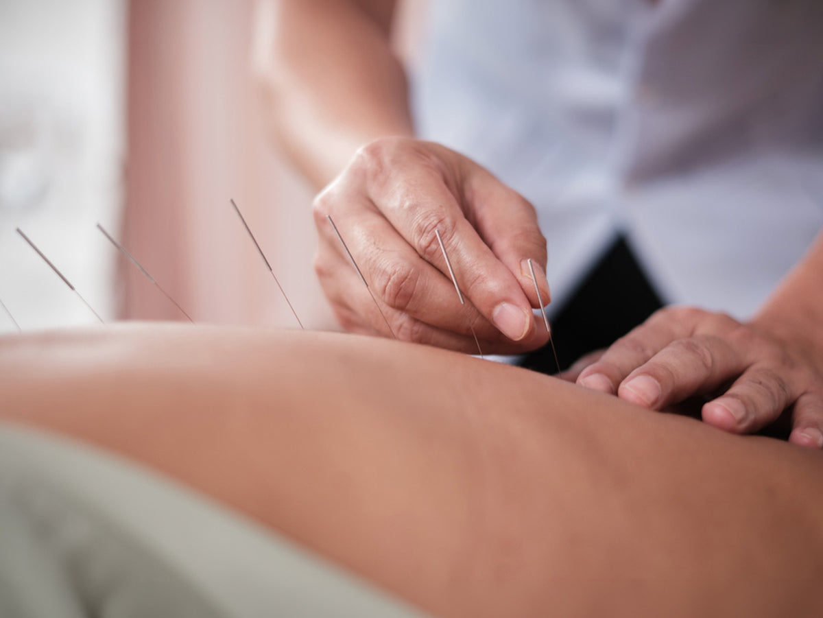 Close-up of a practitioner performing acupuncture on a patient's back