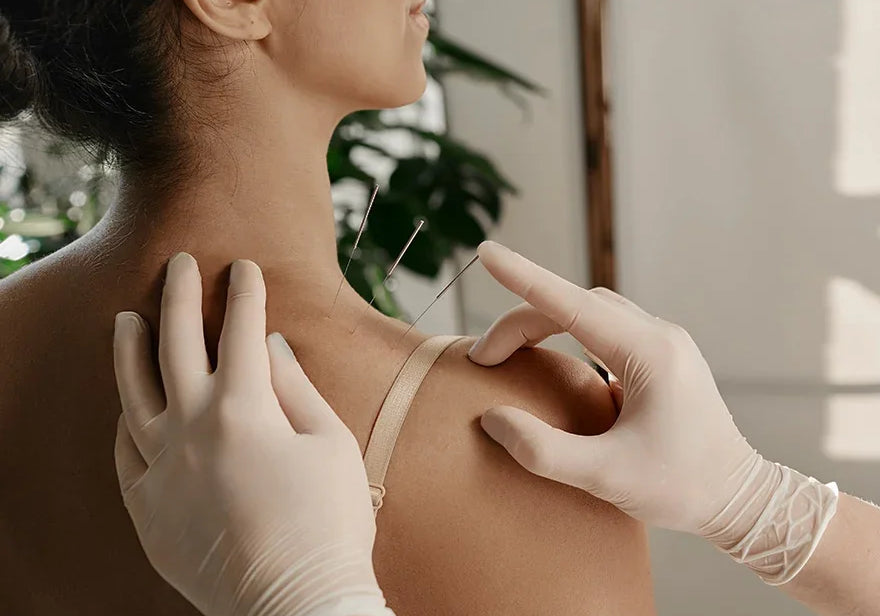 Acupuncture needles being placed on a patient's neck and shoulder by a practitioner in gloves.